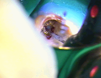 メタルコアを5倍速コントラで切削　2015.09.03　2.gif